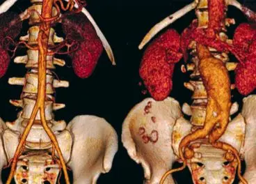 Aneurisma Abdominal